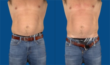 Weight Loss Wooster OH Contouring Before And After Male